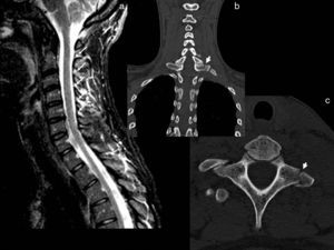 Patient diagnosed with mild cervical symptoms who was assessed by us at 3 weeks for persistent pain. MRI (a) shows oedema in the STIR sequence of the C3–C6 interspinous ligaments (arrows). A subsequent CT scan revealed the existence of transverse fractures in C7 and D1 (arrows in b and c). This case emphasises the need for specialised assessment of CSs.