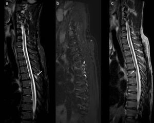 MRI of dorsal column with STIR sagittal sequences (a), Dixon T2FS (b) and T2 (c). Bone marrow oedema can be observed in the spinous process of D5 (arrow in a) and in the pedicles of D5 and D6 (arrows in b), without defining fracture lines. A central protrusion of the disc D5-D6 is shown (arrow in c).