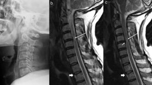 Lateral radiograph of the cervical column (a) and MRI of the cervical column with weighted sagittal sequences in T1 (b) and T2 (c). In the lateral radiograph, only a straightening of the lordosis can be observed. The MRI images show an irregularity and alteration in the signal for the upper D2 disc, consistent with a compression fracture (thick arrows in b and c). A small central protrusion can be observed at C4–C5 level (arrow in c), which associates a slight reduction in the canal and an area of spinal cord oedema (long arrows in b and c).
