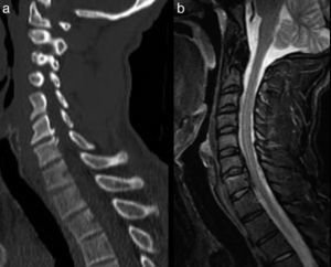 Sagittal reconstruction of cervical CT (a) and STIR sequence of MRI (b) on sagittal planes. The patient exhibited an initial tetraparesis from which he recovered within a few hours. The image shows a posterior osteophyte C6–C7 (a), as well as an image of hypertrophy of the posterior longitudinal ligament at the same level. This previous state could probably have caused a spinal cord shock.