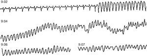 Outpatient sudden death from VF, of a coronary patient treated with amiodarone due to presenting frequent premature ventricular contractions. At 9.02 a.m., the patient suffered a sustained monomorphic VT, followed by a VF at 9.04 a.m. after an increased rhythm of the VT and a widening of the QRS complex.