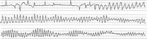 Onset of a VT in torsades de pointes, in a woman treated with quinidine due to presenting bursts of non-sustained VT without coronary heart disease. In this case, VT in torsades de pointes triggered VF.