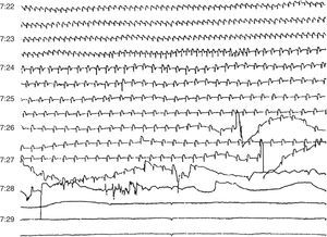 Sudden death due to progressive bradycardia in a patient with acute infarction and probable electromechanical dissociation.