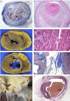 (A) Rupture of vulnerable plaque with secretion of content (Masson