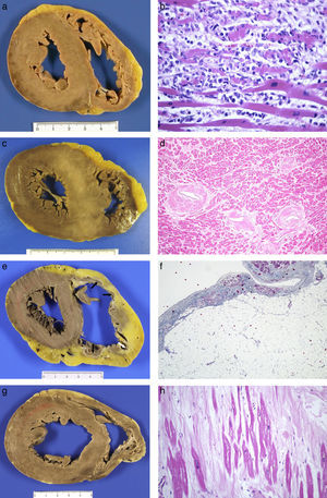 Acute myocarditis: (A) Macroscopically normal heart; (B) Microscopic study finding of myocyte necrosis and lymphohistiocytic infiltrate (HE, 40×). Hypertrophic cardiomyopathy: (C) Asymmetric hypertrophy with fasciculated appearance of the septal myocardium (mutation in the MYBPC3 gene); (D) myocyte hypertrophy, disorder and arterial branches with very thick walls and reduced lumen (HE, 20×). Arrhythmogenic RV cardiomyopathy: (E) Dilated ventricle, with replacement of the myocardium by tissue with a transmural adipose appearance and formation of aneurysms on the anterior, lateral and posterior sides (arrows); (F) Microscopic appearance where adipose wall with fibrous tissue and limited numbers of myocytes along the subendocardial border are observed (Masson
