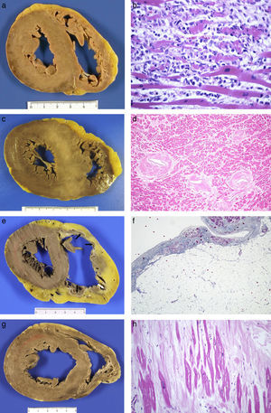 Acute myocarditis: (A) Macroscopically normal heart; (B) Microscopic study finding of myocyte necrosis and lymphohistiocytic infiltrate (HE, 40×). Hypertrophic cardiomyopathy: (C) Asymmetric hypertrophy with fasciculated appearance of the septal myocardium (mutation in the MYBPC3 gene); (D) myocyte hypertrophy, disorder and arterial branches with very thick walls and reduced lumen (HE, 20×). Arrhythmogenic RV cardiomyopathy: (E) Dilated ventricle, with replacement of the myocardium by tissue with a transmural adipose appearance and formation of aneurysms on the anterior, lateral and posterior sides (arrows); (F) Microscopic appearance where adipose wall with fibrous tissue and limited numbers of myocytes along the subendocardial border are observed (Masson's trichrome, 10×). Dilated cardiomyopathy: (G) LV cavity with a 5cm diameter, mitral valve perimeter measuring 12cm and myocardium of normal appearance; (H) replacement fibrosis with hypertrophic and thinned myocytes found in histological study (HE, 40×).