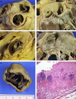 (A) Calcified bicuspid aortic valve. (B) Larger calcified raphe in left sinus which extends into the anterior veil of the mitral valve. (C) Mixed aortic stenosis: senile calcification with commissural fusion. (D) Chronic rheumatic mitral valve disease. (E) Infective endocarditis: vegetations on bioprosthesis (arrow). (F) Fibrin and platelets with numerous bacterial colonies (HE, 40×).