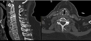 Cervical CT study on sagittal (a) and axial (b) planes. Hypoplasia of the vertebral bodies C5 and C6 with “wasp waist” typical of congenital fusion, with fusion of the facet joints, without fusion of the spinous processes is shown. Anterior osteophytes identified, mainly in the bodies adjacent to the vertebral fusion and rectification of the lordosis, conditioning a canal stenosis in C3 and C4. A discrete subluxation of C2 on C3 is observed, without associated atlantoaxial or atlanto-occipital subluxation, or hypoplasia of the atlas or odontoid hypoplasia. Undisplaced fractures in the C5, C6 and C7 spinous processes (arrows).
