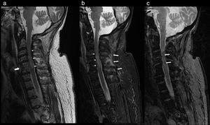 Cervical MRI study on sagittal planes, sequences FSE T2 (a), STIR (b) and GRE T2* (c). In the FSE T2 and STIR sequences, significant canal stenosis in C3–C4 is shown, with hyperintense spinal cord signal (thin arrows), in relation to oedema secondary to spinal cord compression. Congenital vertebral fusion of C5–C6 is also identified, with a very rudimentary disc (thick arrow in “a”). In the STIR sequence, oedema between the spinous processes C4–C7 and adjacent paraspinal muscles is identified, in relation to partial injury to the interspinous ligaments (thick arrows in “b”). The gradient echo sequence T2* shows an intramedullary hypointense linear image at C3 and another punctiform at C5 in relation to haemorrhagic content (arrows in “c”) a finding for a poor prognosis.