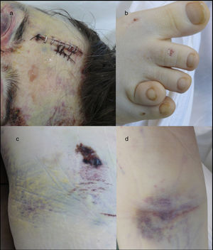 External examination. Note the forehead impact injuries (sutured contusion and bilateral orbital haematoma (a). In (b), partial hypoplasia-syndactyly of the fourth toe can be seen. The images in “c” are located in the right hemiabdomen, responding to a friction mechanism. The injuries visible in (d) occur on the front side of the right forearm.