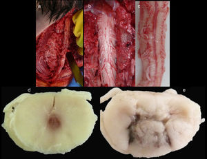 Images of the spinal cord trauma macroscopic study. In “a”, part of the spinal autopsy at the time of elevating the laminar webbing is shown. In “b” the webbing has been removed and the dorsal dura mater opened up to extract the complete cervical spinal cord, from the foramen magnum, along with the encephalon. No external injuries are identified on the spinal cord or spine additional to the fractures to the spinous processes. In “d” and “e”, corresponding to the specimen fixed in formalin, an intramedullary haemorrhagic focus C2–C3 (“d”) and C5–C6 (“e”) is identified, this last one more extensive and affecting anterior and posterior horns. In “e”, a softened intramedullary region is also identified, probably due to secondary injury.