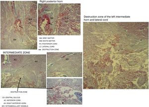 Microscopic study of spinal cord cut at level C3 with Martin