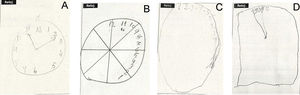 (A) A normal clock drawing test in a subject with no disorder. (B and C) The result of the test in two women (aged 89 and 78) with Alzheimer's disease. (D) The result in an 84-year-old patient with vascular dementia.