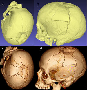 Image corresponding to the reconstruction in isosurface and to volume of a fractured skull. (a and b) Isosurfaces. These are multiple triangles reconstructed from points located on the vertices. (c and d) Reconstruction of volume. Here, each individual point has colour, grey-scale and other properties, which permits very detailed, realistic reconstructions, although printing the model is unfeasible. In contrast, 3D printing is possible with isosurfaces.