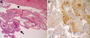 (a) Images of cysts of Rathke's pouch, which show prevailing monolayer columnar epithelium of cystic wall (arrow) with focal phenomena of squamous metaplasia (arrowhead); (b) Proportion of healthy pituitary tissue removed during resection of the cyst wall, visible with immunohistochemical studies that detect the weak positivity for ACTH and FSH.