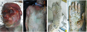 Photographs of the face, trunk and limbs of case No. 34.