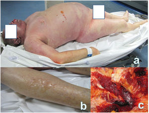 (a) Emphysematous body. (b) Blisters on the lower limbs. (c) Bubbles in the vascular bed of the open subclavian artery.