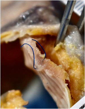Image showing the dehiscence of the proximal stitches and the separation of the patch.