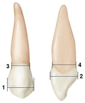Variables measured in the canine teeth: (1) coronal mesiodistal diameter (MDcor), (2) coronal buccolingual diameter (BLcor), (3) cervical mesiodistal diameter (MDcer), and (4) cervical buccolingual diameter (BLcer).