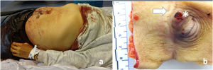 (A) Body with blood on the hands and the abdominal and pelvic zones, as well as on the clothing in contact with the same. (B) Ulcerated umbilical hernia with rupture of varices (*), midline laparotomy scar ().