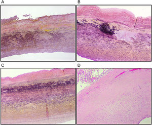 Medial degeneration lesions. (A) Mucoid extracellular matrix accumulation (translamellar). (A,B,C) Elastic fibre fragmentation and loss. (C) Lamellar medial collapse. (D) Smooth muscle cell nuclei loss. Weigert