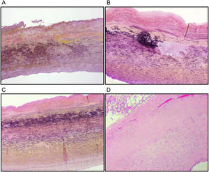 Medial degeneration lesions. (A) Mucoid extracellular matrix accumulation (translamellar). (A,B,C) Elastic fibre fragmentation and loss. (C) Lamellar medial collapse. (D) Smooth muscle cell nuclei loss. Weigert's stain for elastic fibres (A,B,C), haematoxylin-eosin (D).