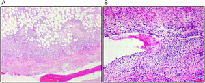 Granulation tissue. (A) In the aortic adventitia. (B) In the dissection plane in the medial later.