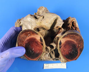 Sagittal view. Aneurysmatic dilation and thrombus in its interior.
