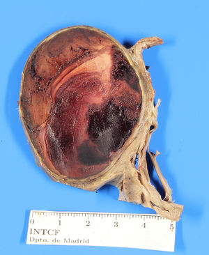 Close-up of the aneurysmatic dilation and the acute thrombosis contained within it.