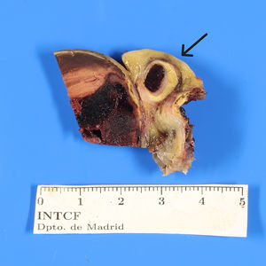 Please note the difference in diameter between the proximal segment (black arrow) and the middle and distal segment of the right coronary artery. Please also observe the presence of occlusive thrombosis in both segments of the right coronary artery.