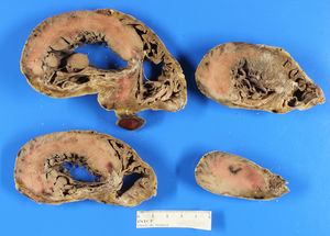 Cross-sectional transverse views of both cardiac ventricles. Myocardial scarring on the posterior wall of the left ventricle, posterior septum, and posterior wall of the right ventricle, linked to chronic ischaemic heart disease.