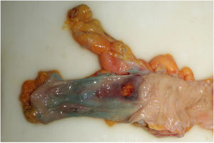 Turquoise mucosa in the colon after administration of methylene blue by colonoscopy. (For interpretation of the references to colour in this figure legend, the reader is referred to the web version of this article.)