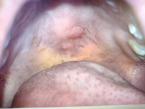 Whitish papillomatous lesion, associated with another more flattened papule, on the palatine raphe of a 7-year-old girl. Diagnosis confirmed by PCR molecular study of condyloma acuminatum by human papillomavirus.