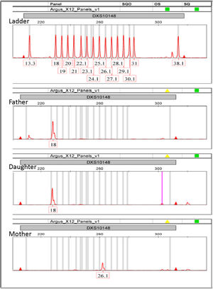 Electropherogram showing the null allele inferred between mother and daughter for DXS10148.