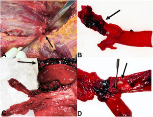 (A and B) Dissection (black arrow) of extracranial left internal carotid artery. (C) Haemorrhagic infiltration of retroperitoneal perivascular soft tissues (black arrow). (D) Dissection and rupture (black arrow) of left common iliac artery.