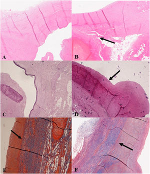 (A) Dissection and haemorrhagic infiltration of extracranial left internal carotid artery (HE; 2.5×). B) Dissection and haemorrhagic infiltration (black arrow) of left common iliac artery (HE 2.5×). (C) Extracranial left internal carotid artery characterised by marked muscular-elastic atrophy of tunica media (Elastic stain; 4×). (D) Left common iliac artery characterised by marked muscular-elastic atrophy (black arrow) (Elastic stain; 4×). (E) Extracranial left internal carotid artery characterised by medial and adventitial fibrosis (black arrow) with altered parietal structure (Trichrome stain; 4×). (F) Left common iliac artery with medial and adventitial fibrosis (black arrow) with damaged parietal structure (Trichrome stain; 4×).