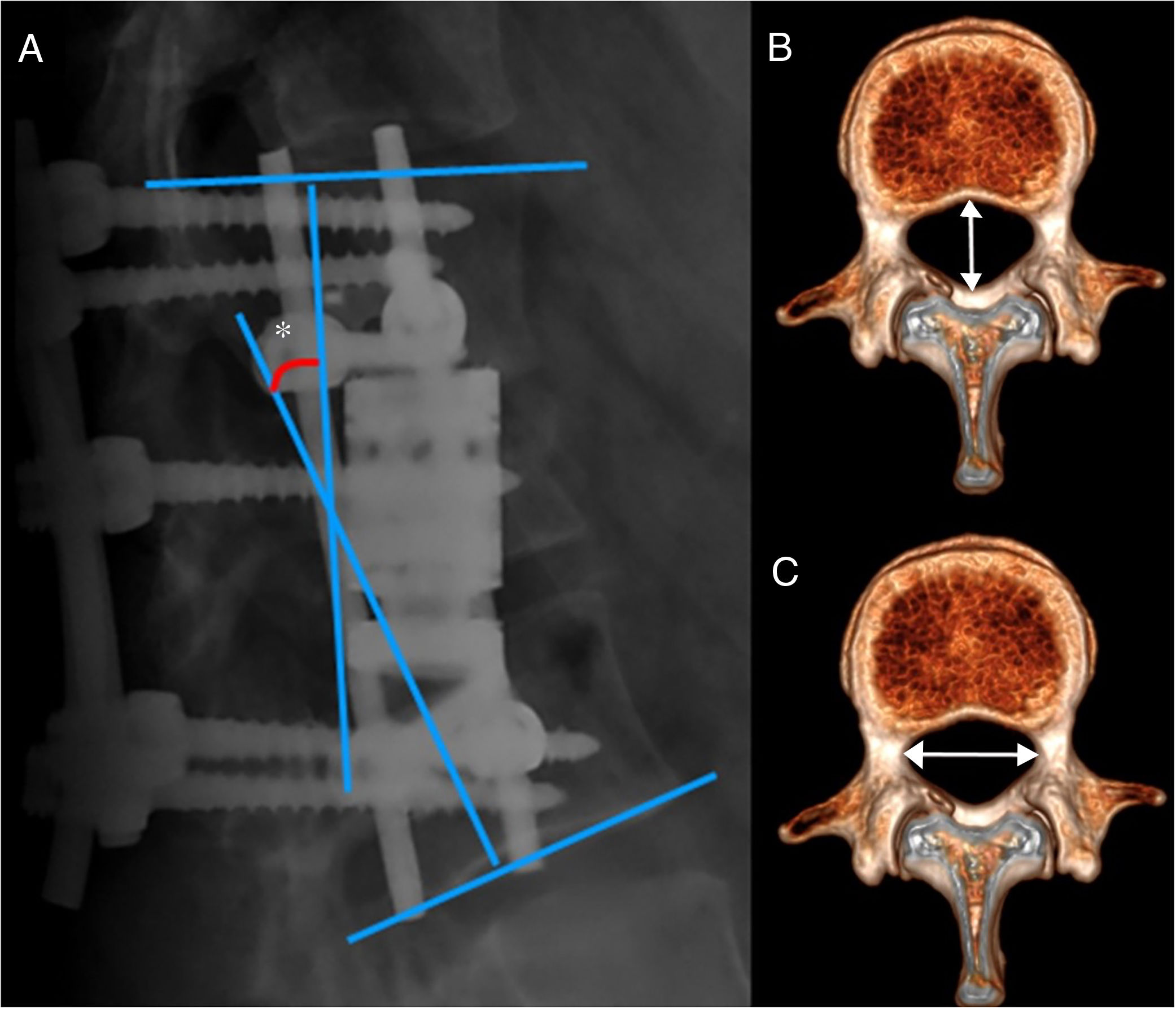 Morphometrical evaluation of decompression obtained through corpectomy ...