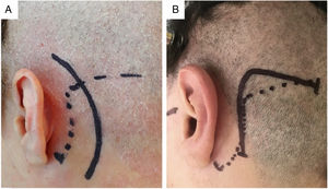 (A) Classical linear incision. (B) “Modified Dandy” incision.