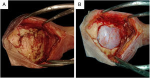 Image showing exposure size. (A) Skin opening with exposure of the asterion. (B) Dural exposure.