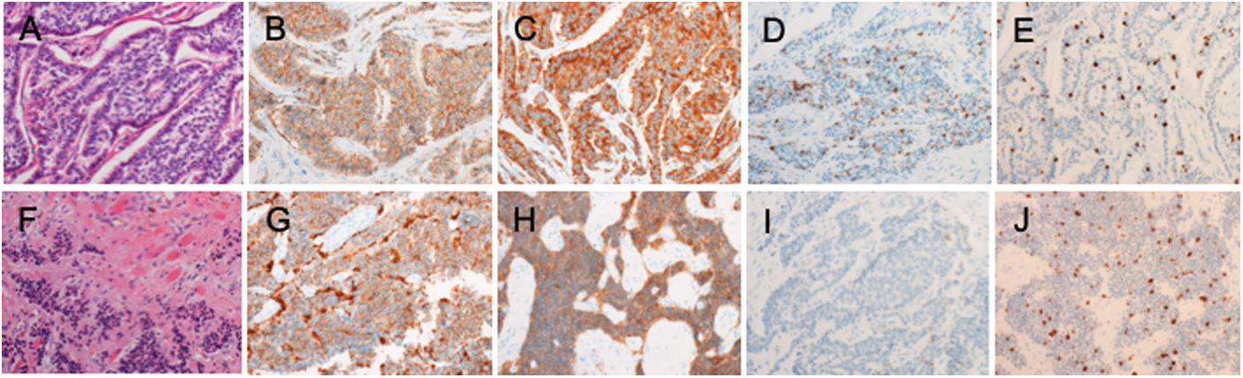Discrepancy in the Ki67 labeling index of brain and orbital metastatic ...