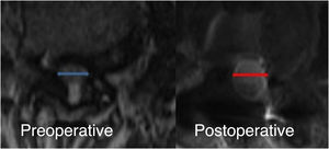Measurement of transverse canal diameter at the surgically treated segment in axial lumbar MRI sections.