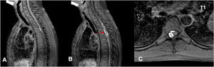 First episode (November 2012). (A and B) Sagittal MRI, T1-weighted sequence; (C) Axial MRI, T1-weighted sequence. Intra-spinal lesion compatible with hematoma (red arrow); it is hyperintense on T1-weighted sequence with anterior and right lateral subdural location, cranial limit slightly above T1 and slightly lower caudal T5. It originates medullary displacement towards the left lateral region.