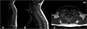 Second episode (March 2020). (A-B-C) Sagittal MRI, T1-weighted sequence; (C) Axial MRI, T1-weighted sequence. Visualization of intra-spinal hematoma in subdural location, only visible in the T1-weighted sequence where it presents isointense signal behavior compared with the spinal cord (red arrow), observing obliteration of the subarachnoid space from the clivus to T1 (anterior) and from C3–C4 to T1 (anterior and posterior).