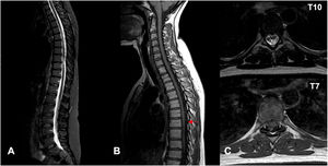 Third episode (December 2020). (A) Sagittal MRI, T2-weighted sequence; (B) Sagittal MRI, T1-weighted sequence; (C) Axial MRI, T2 (superior) and T1(inferior) -weighted sequences. Extra-axial occupancy suggestive of subdural hematoma from T3 to T10 (red arrow), consisting of heterogeneous hypointense signal in T2-weighted sequences and discrete hyperintensity in T1-weighted sequences.