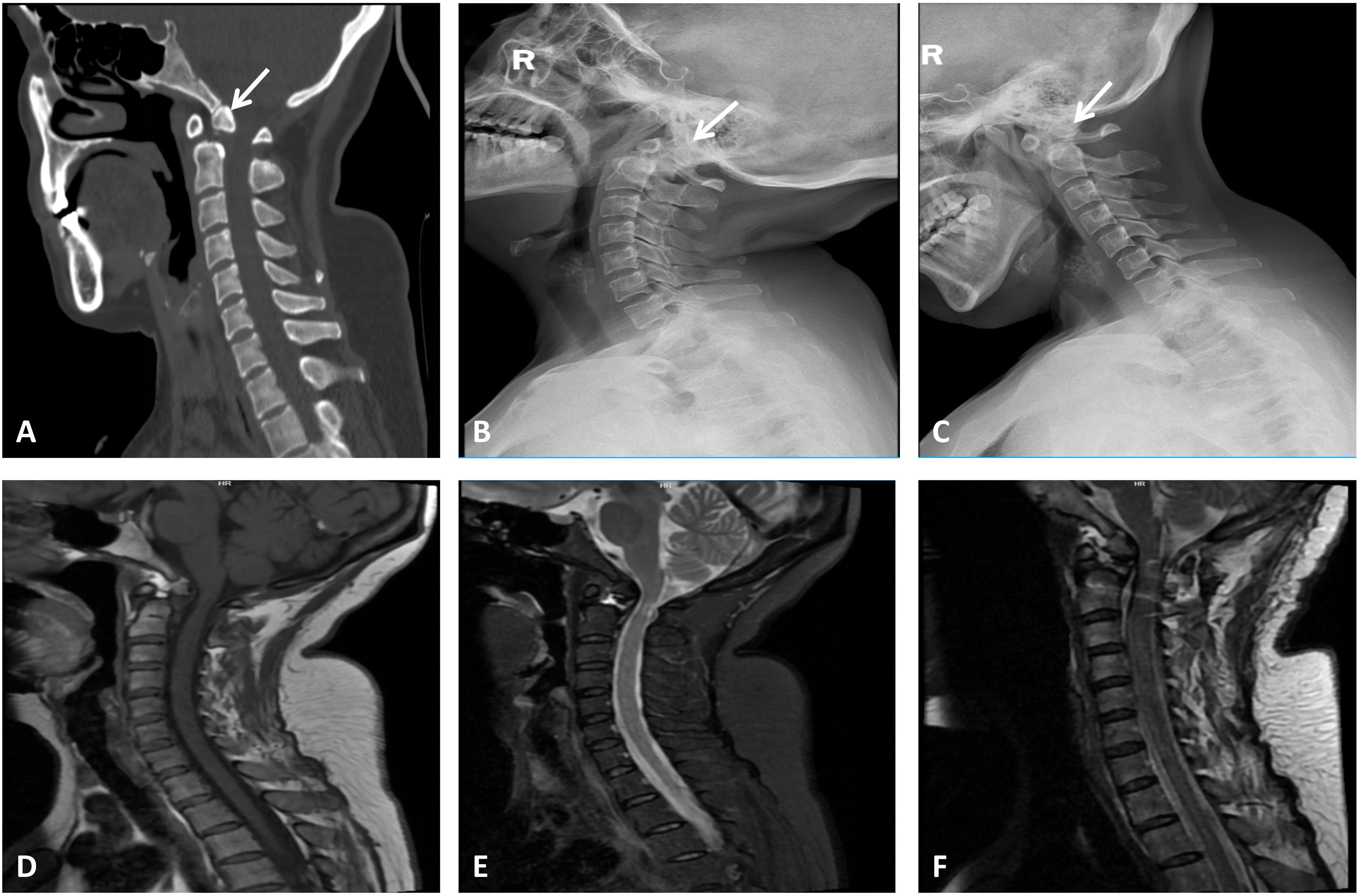 rare-atlantoaxial-dislocation-secondary-to-os-odontoideum-a