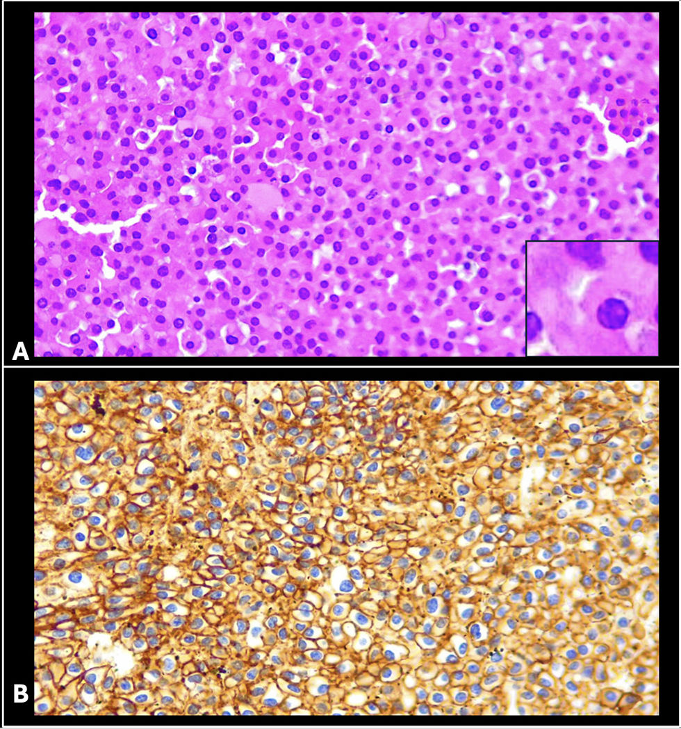 Multiple myeloma mimicking olfactory sulcus meningioma: Case report and ...