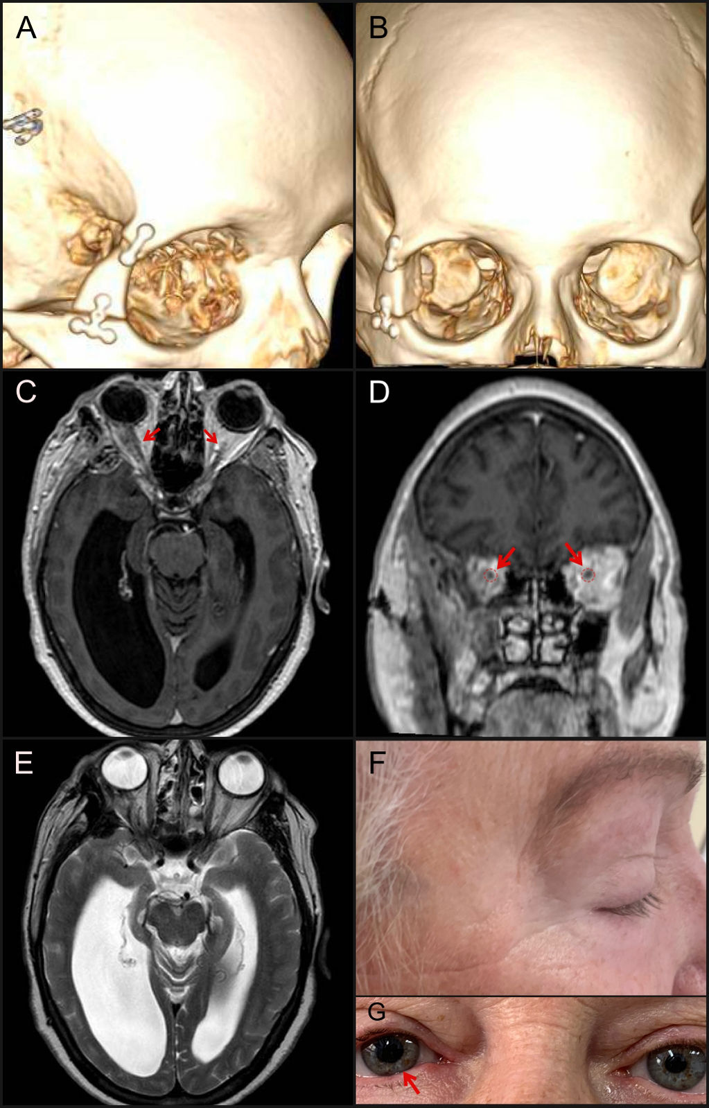 Lateral micro-orbitotomy as the technique of choice for orbital ...