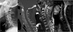 A. Cervical lateral radiograph: hypodense lesions of C5/C6 vertebral bodies with slight listhesis from C4 to C5. Prevertebral calcification is compatible with abscess formation and increased anterior soft tissue volume (arrows); B. Cervical lateral computed tomography shows erosion and radiolucency of the anterior aspect of C5/C6 vertebral bodies (arrow); C and D. Cervical sagittal T2 and STIR weighted contrast magnetic resonance showing prevertebral collection, increased prevertebral space (double arrow) associated with osteomyelitic signs in the C5/C6 vertebrae, sinus tract from the esophagus and epidural abscess with mild obliteration signs of the spinal cord (arrow).