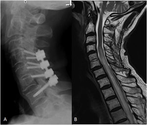 A. Lateral cervical radiograph at six months post-operation: posterior fixation with bilateral facet screws at C4-C5-C6 and pedicle screws at C7 six months after surgery; B. MRI at 6 moths post- operation showed resolution of C5/C6 osteomyelitis and no evidence of abscesses or sinus tracts, although it showed intramedullary expansive high signal (C4-T11), anterior medullary synechiae, and persistent dural and arachnoid enhancement throughout the cord.