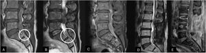 Lumbar spine MRI sagittal view, T1 and T2-weighted (panel A, B) exhibiting an intradural lesion from L3 to L5 appearing isointense to CSF on T1 and hypointense on T2. On the bottom of the thecal sac, a slight hyperintense on T1 and low signal level on T2-weighted suggested subacute subarachnoid bleeding (White circle). The gadolinium-enhanced T1-weighted sagittal view (panel C) shows a peripheral enhancement of the intradural lesion. The 8-month postoperative lumbar spine T2 and gadolinium-enhanced T1-weighted MRI sagittal views exhibited surgical and radiation therapy inflammatory changes without tumor recurrence (panels D and E).